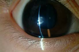 abnormalities in the development of the anterior segment of the eye, specifically the cornea, iris, and lens