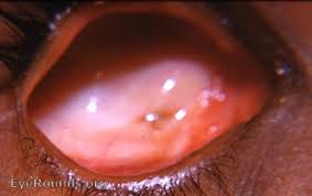 Anophthalmos is an ophthalmopathology characterized by the absence of the eyeball in the orbit