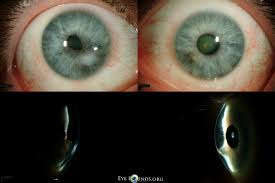 Peters abnormalities is  the development of the anterior segment of the eye, specifically the cornea, iris, and lens