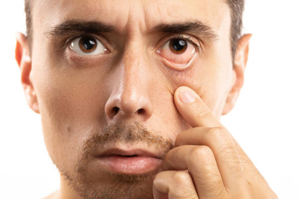 Man checking condition of his Asthenopia eye on white background