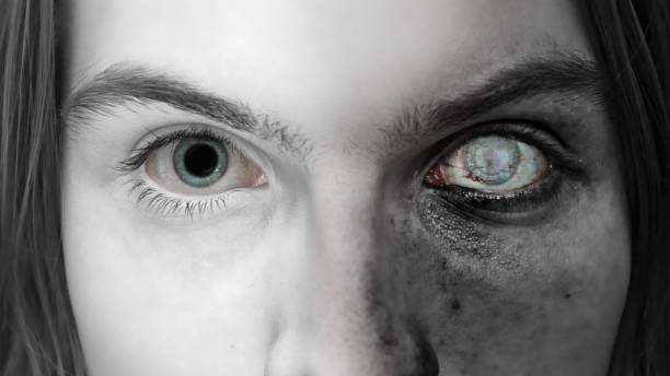 Anophthalmos