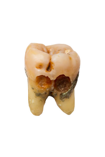 Enamel hypoplasia Tooth decay. Dental care background. Isolated on white background.