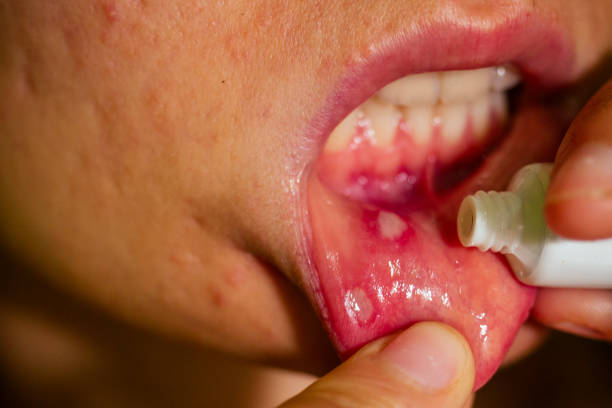 close - up on the lip with aphthous stomatitis applying antibacterial cream