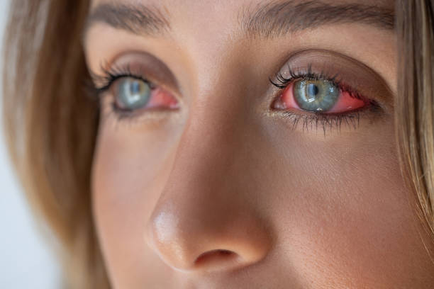 (Conjunctivitis )Pink eye suffering from allergy