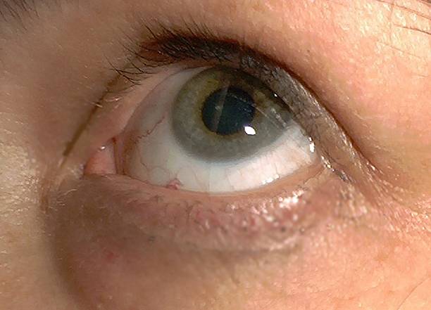 A closeup of an eye Peters anomaly.