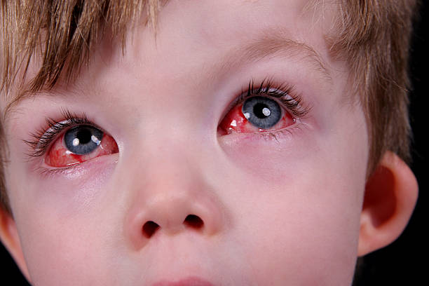 Red eye suffering from allergy