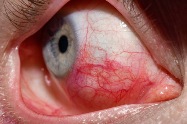 Large close-up of an open Peters anomaly. eye, red veins in the eye