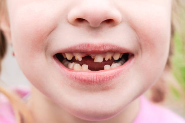 The kid Shows Off first Missing Tooth. Children without one enamel hypoplasia tooth smiles