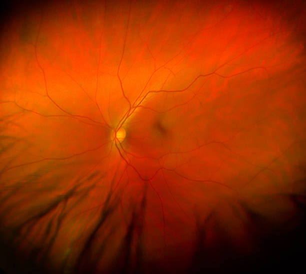 Retinal abiotrophy