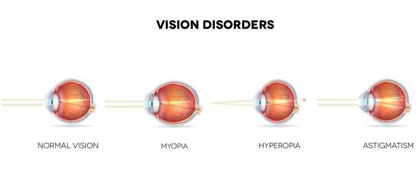 Eyesight disorders. Normal eye, Astigmatism, hyperopia and myopia.