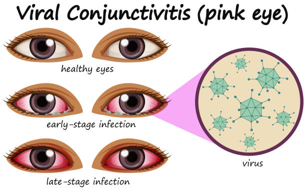 Human eye disease with viral Adenoviral Conjunctivitis illustration