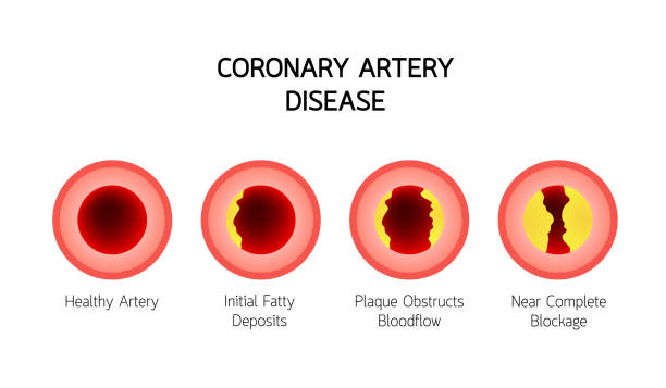 Artery disease. Vector illustration isolated on black background.