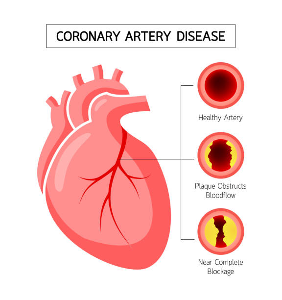 Coronary Artery Aneurysm heart awareness concept. Illustration isolated on white background.