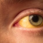yellow staining of the sclera of the eye in diseases of the liver, cirrhosis, hepatitis, bilirubin