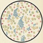 Microscopic view of human white blood cells and salmonella typhi bacteria from a patient with typhoid fever. Vintage etching circa mid 19th century.