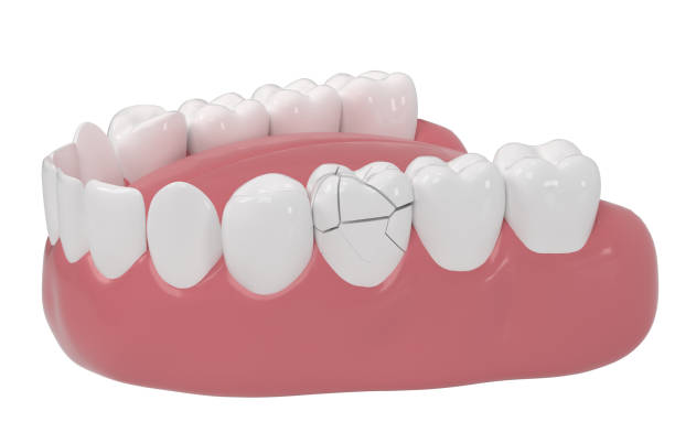 Crack tooth, tooth disease, 3d rendering. Computer digital drawing.