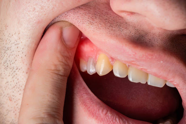 Red and swollen gums in a man. Gum disease gingivitis, gumboil and inflammation