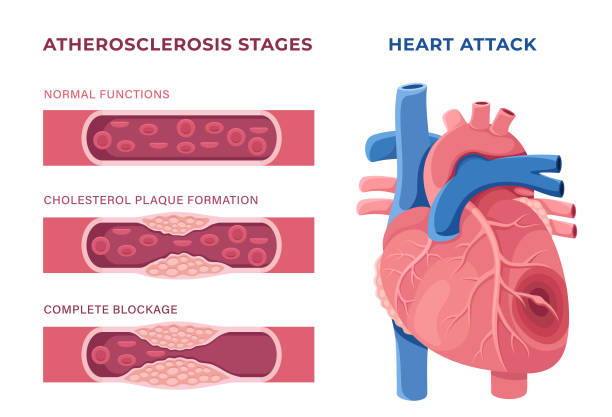 Heart Failure concept. Unhealthy heart. Heart with atherosclerotic plaque.