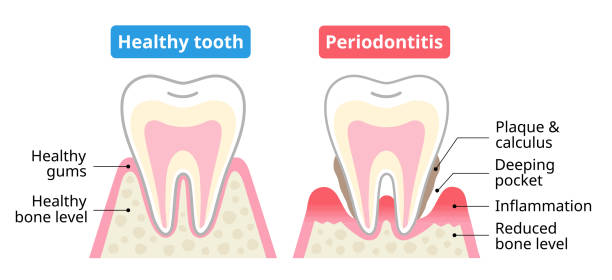 healthy tooth and periodontitis illustration. Isolated on white background