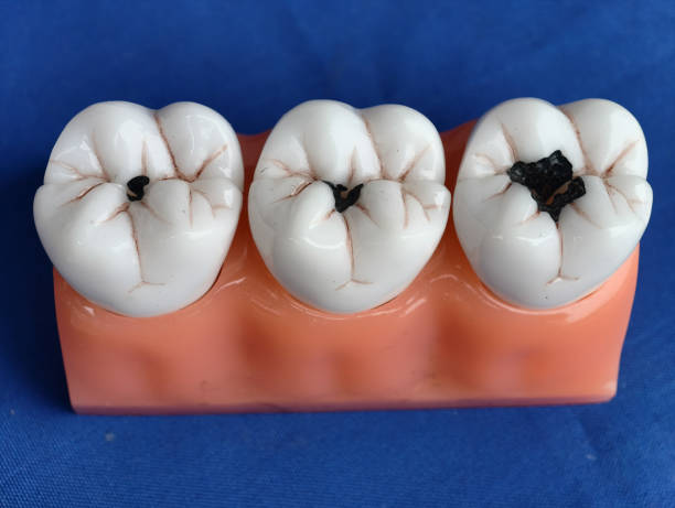 Models of dental caries at different levels.