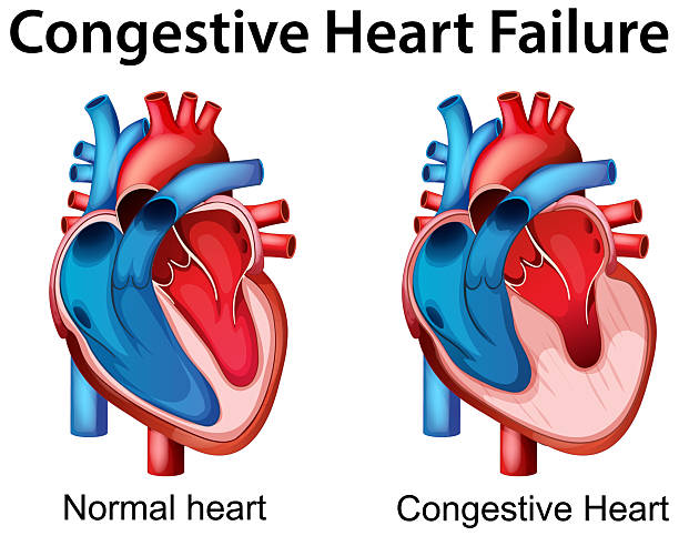 Detailed vector illustration comparing normal and congestive hearts. Vivid colors highlight anatomical differences and medical conditions