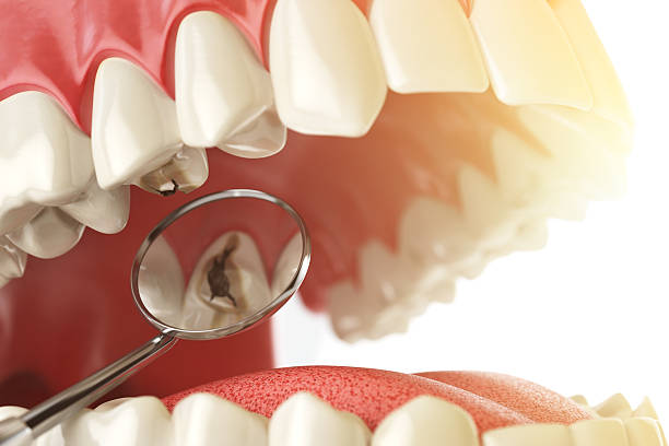 Human Dental caries , hole and tools. Dental searching concept. Teeth or dentures. 3d illustration